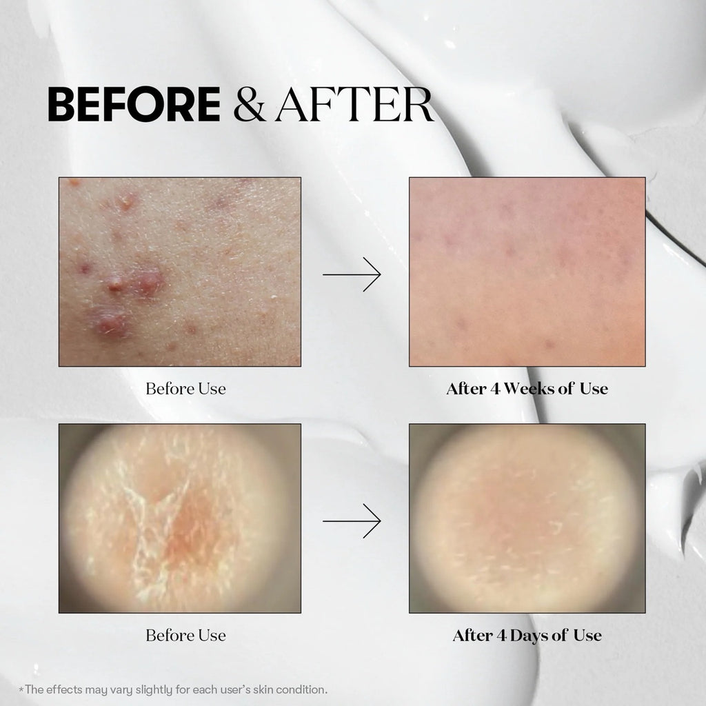 Before and after skin treatment comparison on VT Cosmetics Reedle Shot 300 Essence 50ml