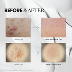 Before and after skin treatment comparison on VT Cosmetics Reedle Shot 300 Essence 50ml