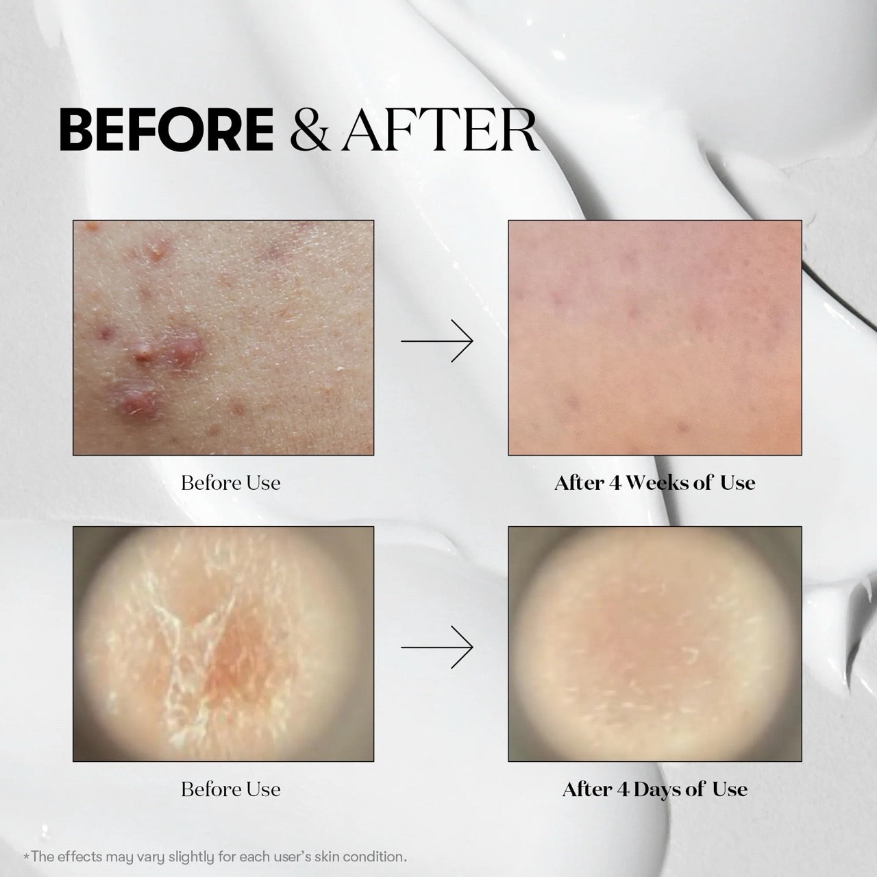 Before and after skin treatment comparison on VT Cosmetics Reedle Shot 300 Essence 50ml